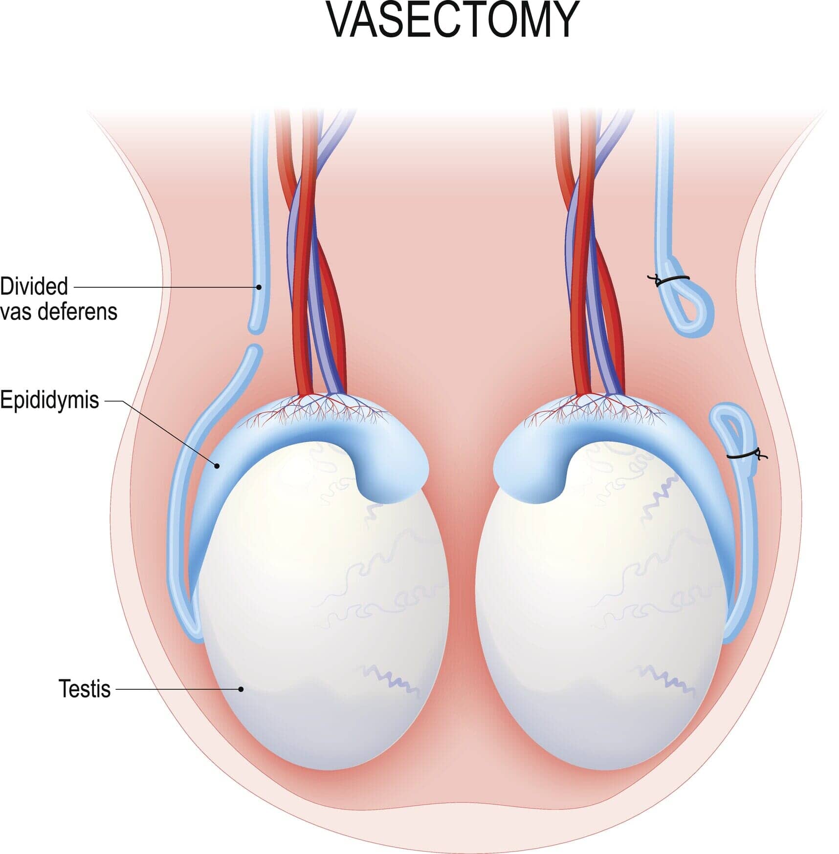 Vasectomy Reversals