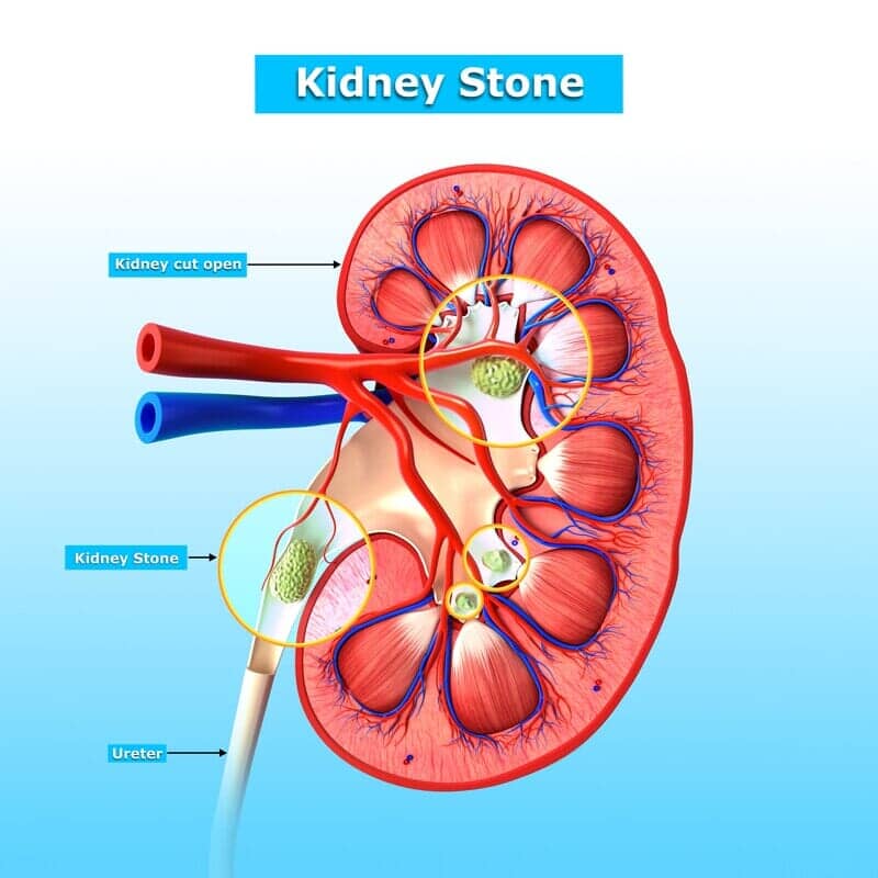 Kidney Stones